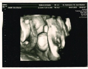 D Ultraschall Bild von Frauenarzt Dr. Rotmann